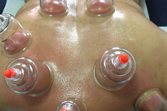 Cupping in treatment