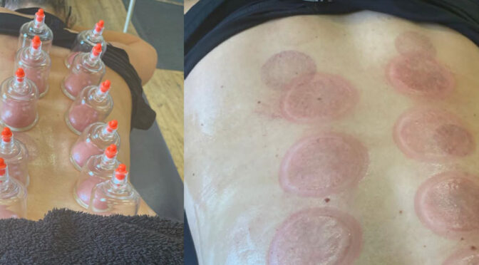 Cupping
